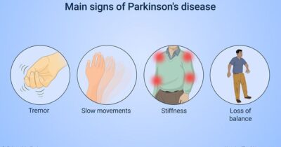 CBD and Parkinson’s Disease