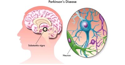 CBD and Parkinson’s Disease