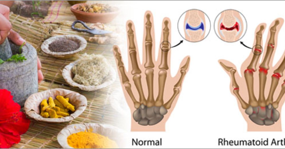 Ayurveda and Arthritis
