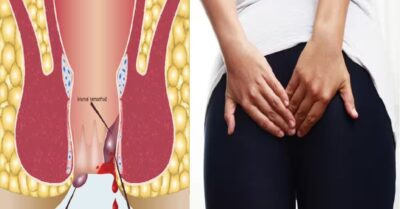 Can Ayurvedic cure Piles and Fissures
