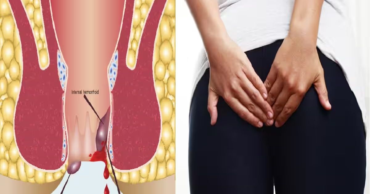Can Ayurvedic cure Piles and Fissures