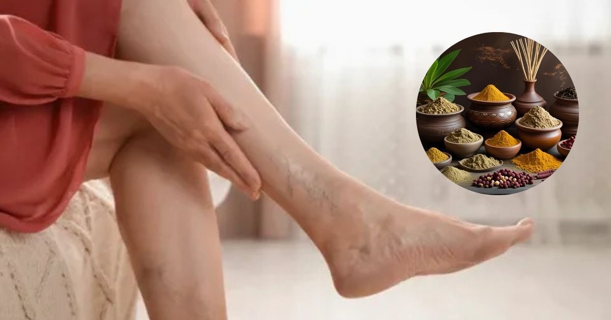Can Ayurvedic Treatment Help Varicose Veins