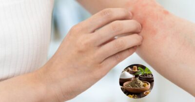 Ayurvedic Ways to Get Rid of Skin Allergies