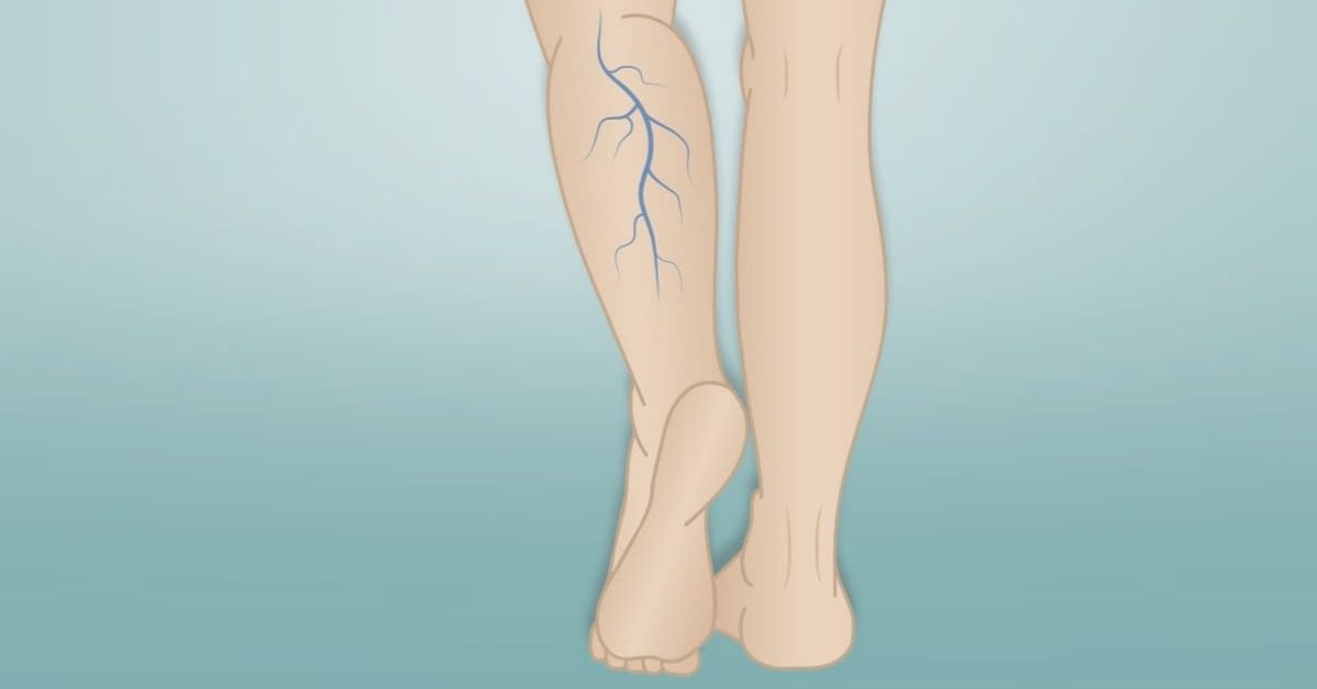 Can Ayurvedic Treatment Help Varicose Veins