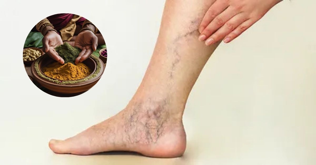 Can Ayurvedic Treatment Help Varicose Veins
