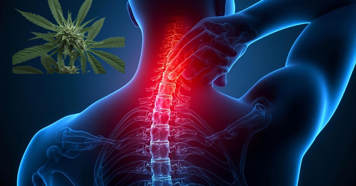 CBD for Severe Neck and Shoulder Pain
